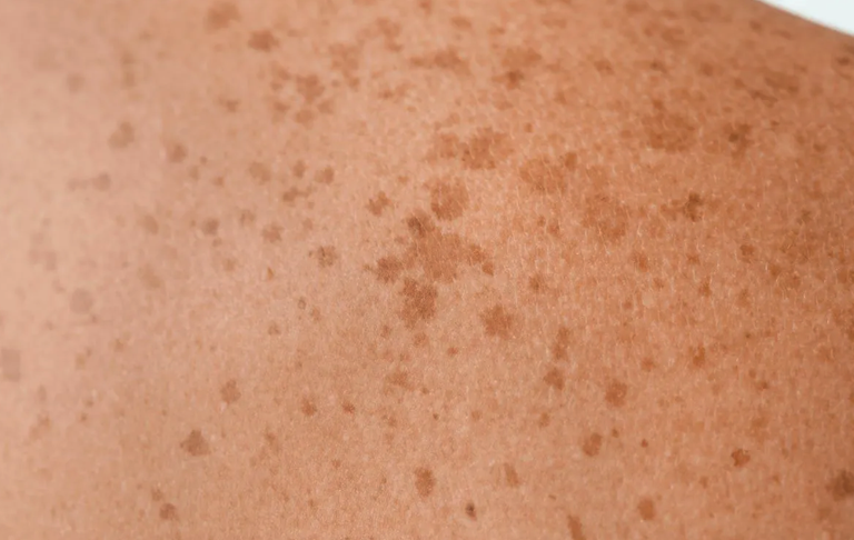 Azaleko minbizia blokeatzea lortu dute giza azal artifiziala erabiliz