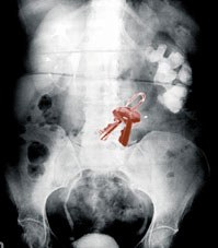 Erradiografia giltzaren kopia egiteko Erradiografia giltzaren kopia egiteko