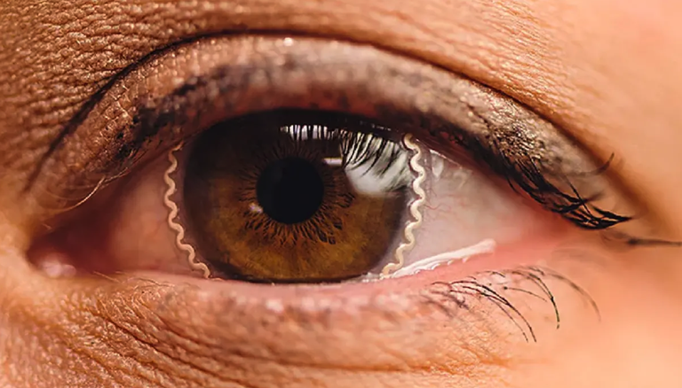 Glaukoma prebenitzeko lentilla adimentsuak garatu dituzte