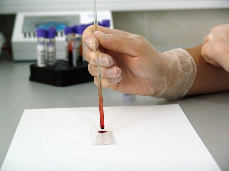 Proba berri bat GIBa eta hepatitis B zein hepatitis C birusak antzemateko gai da odol tanta lehor batetik abiatuta Proba berri bat GIBa eta hepatitis B zein hepatitis C birusak antzemateko gai da odol tanta lehor batetik abiatuta