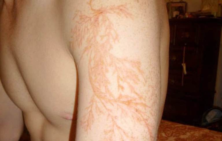 Tximistek egindako tatuaje naturalak Tximistek egindako tatuaje naturalak