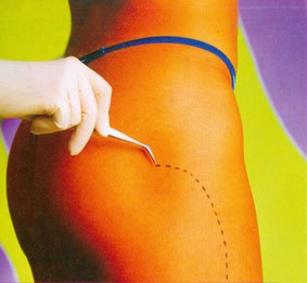 Ustelkeria eta liposukzioa Ustelkeria eta liposukzioa